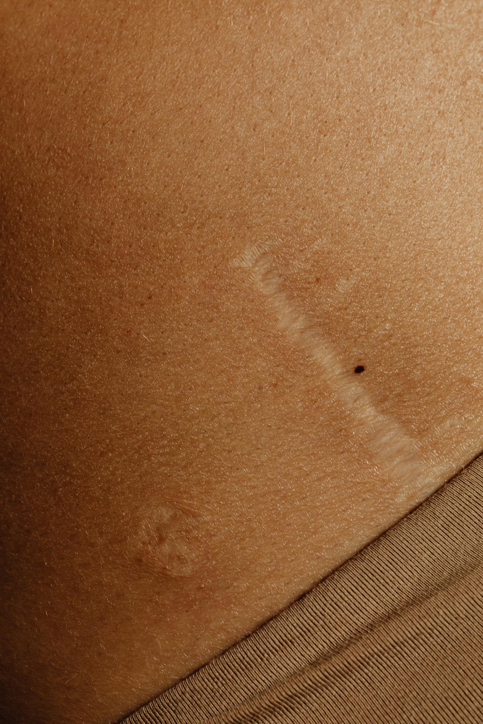 A scar on the body, representing hidden emotional scars
